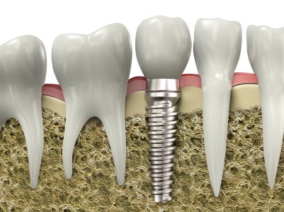 Photo of Dental Implant
